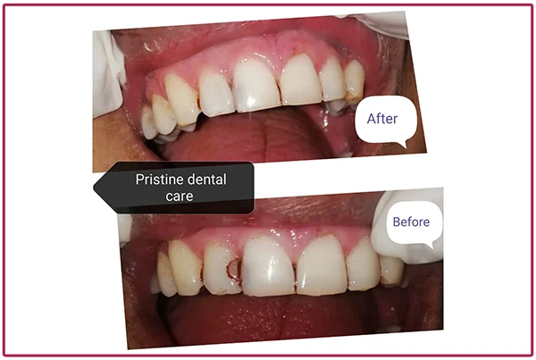 Treatment Pictures