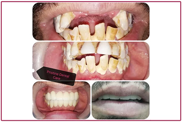 Treatment Pictures