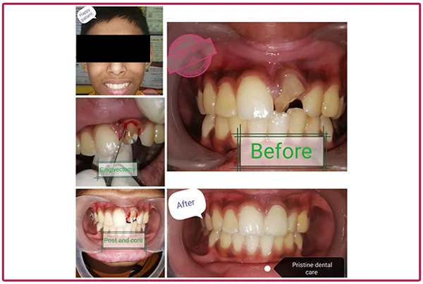 Treatment Pictures