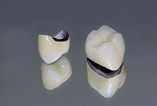 PFM Crowns