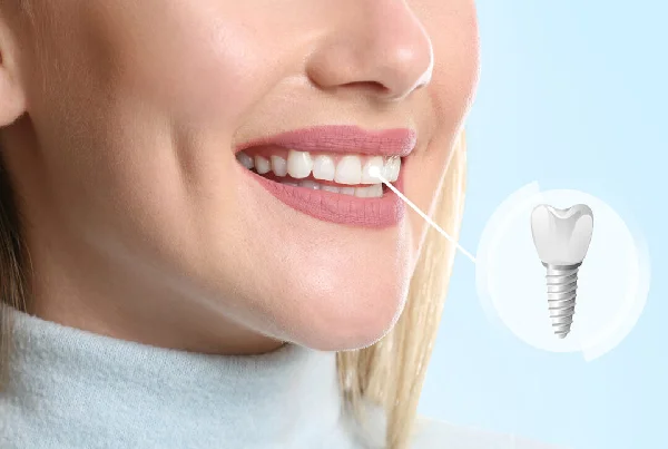Dental Implant