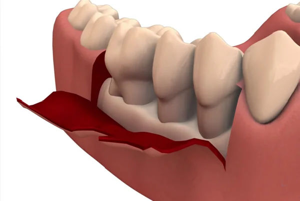 Flap  Surgeries