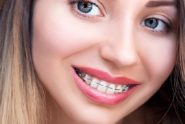 Metal and Tooth Coloured Ceramic Braces