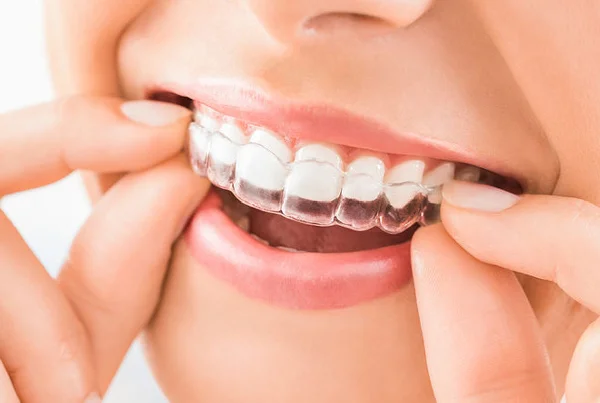 Invisible Aligners