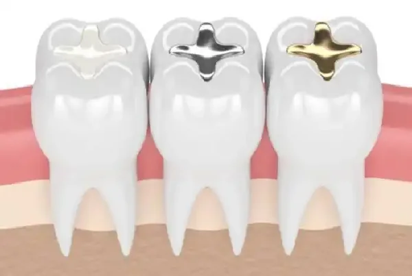 Tooth Coloured Filling