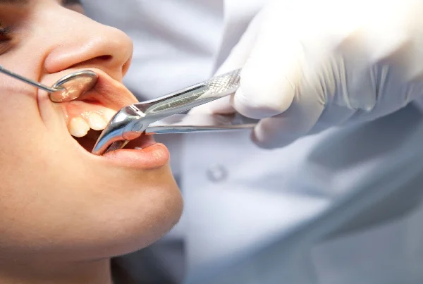Extractions